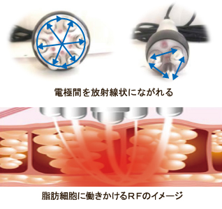 キャビ+ラジオ波】PYR(パイラ) バースト ネオの通販情報 - エステ用品