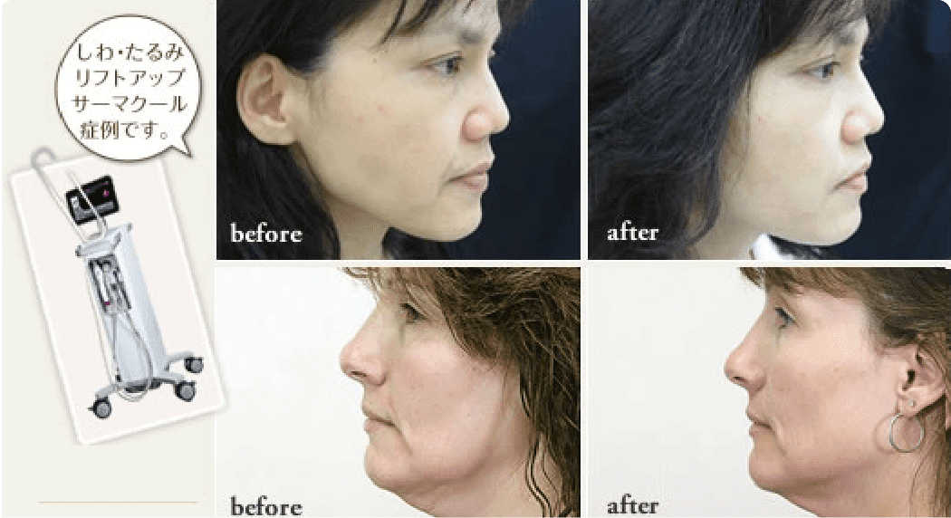 サーマクールでリフトアップなら大阪梅田の藤井クリニック