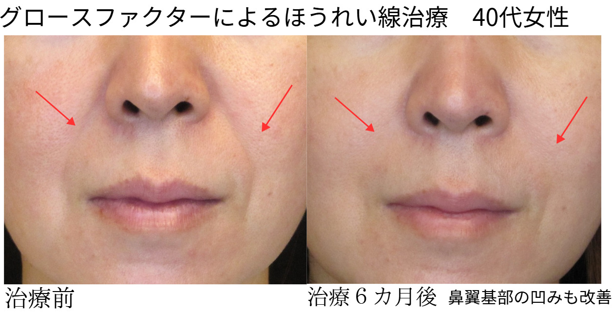 6種類の【口元のシワ】｜シワ専門クリニック院長が完全解説