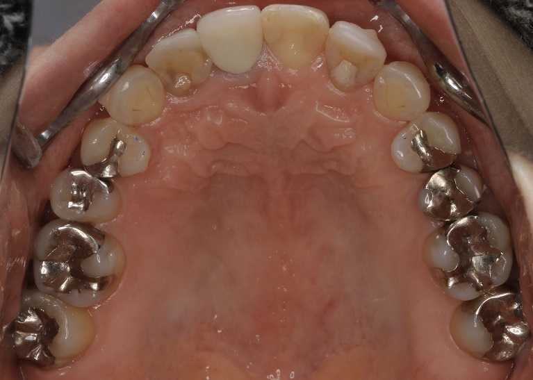 セラミック治療なら大阪・天王寺の小室歯科
