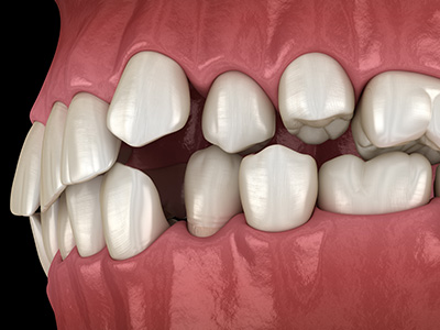 咬合再構成｜新百合ヶ丘の歯医者｜カズトシデンタルオフィス｜川崎市麻生区