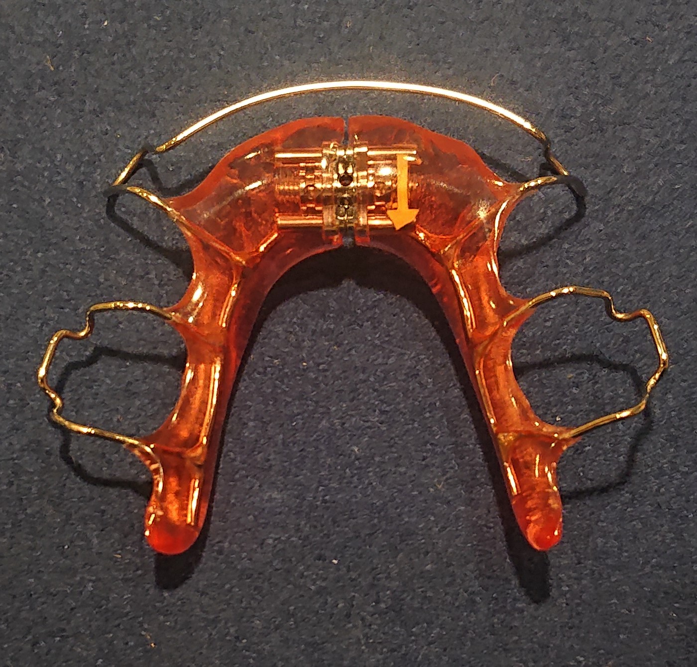 拡大床の取り扱いやネジの回し方は？ - 北千住SHUN矯正歯科