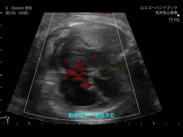 心エコーハンドブック 先天性心疾患｜付録動画｜見本サイト