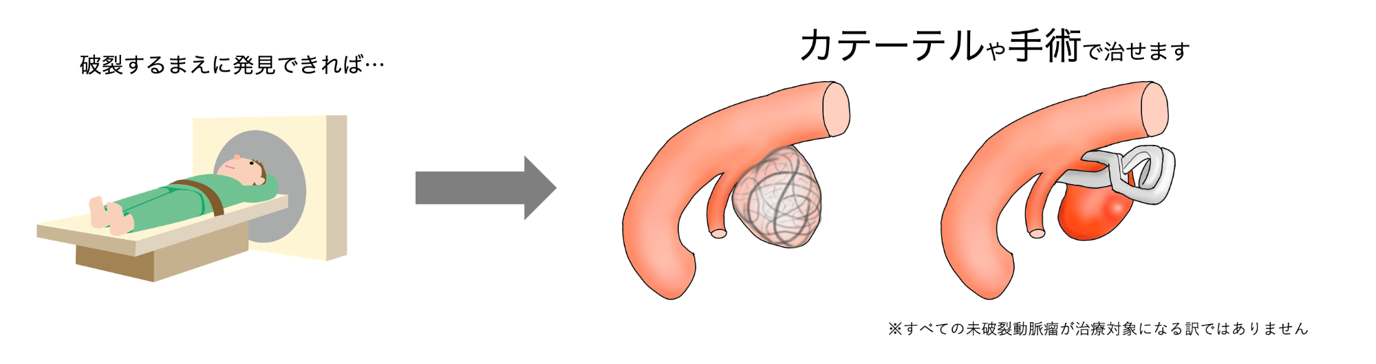 脳動脈瘤／藤枝市立総合病院