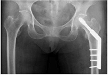 大腿骨近位部骨折｜疾患ガイド｜患者さん向けガイド｜原三信病院