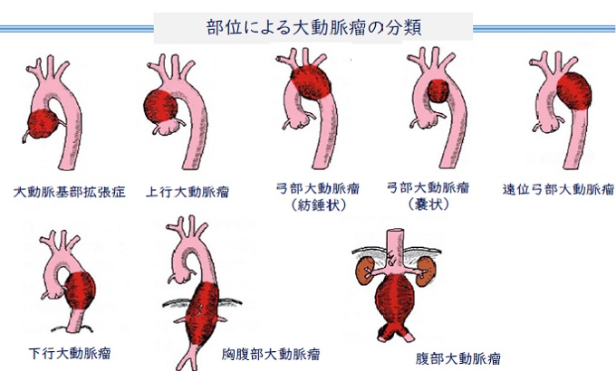 大動脈ステントグラフト内挿術：日立総合病院