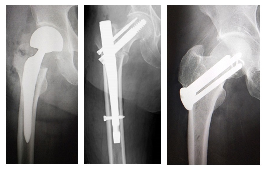 大腿骨近位部骨折