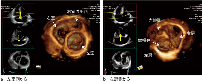 ACUSON SC2000」によるリアルタイムFull Volume Imagingの活用法