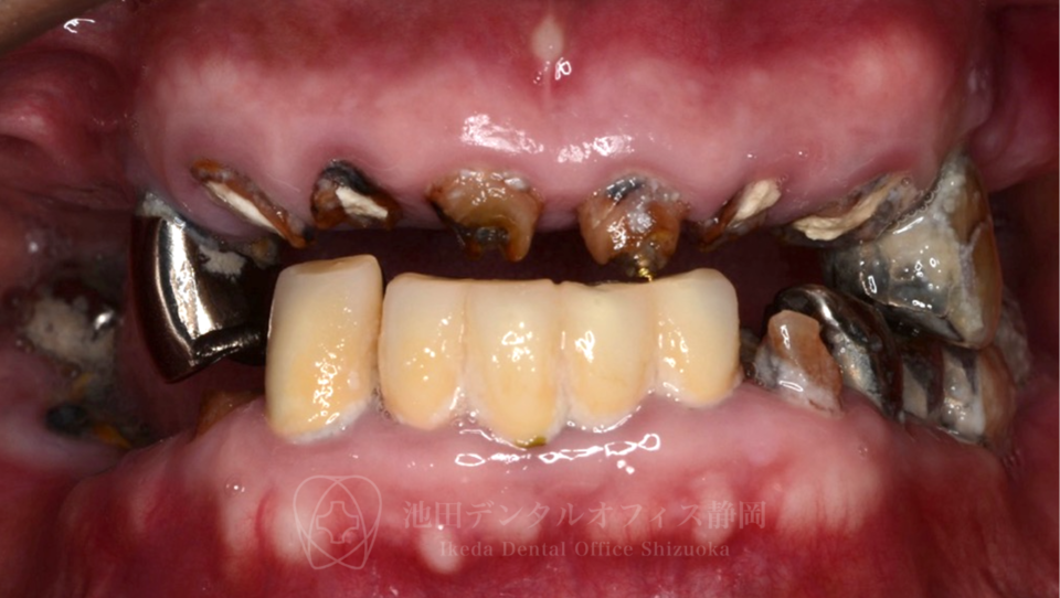 歯がボロボロ」で悩んでいる方へ｜池田デンタルオフィス静岡