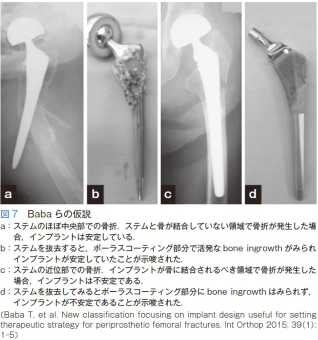 医学界新聞プラス ［第3回］人工骨頭術後ステム周囲骨折 | 2024年