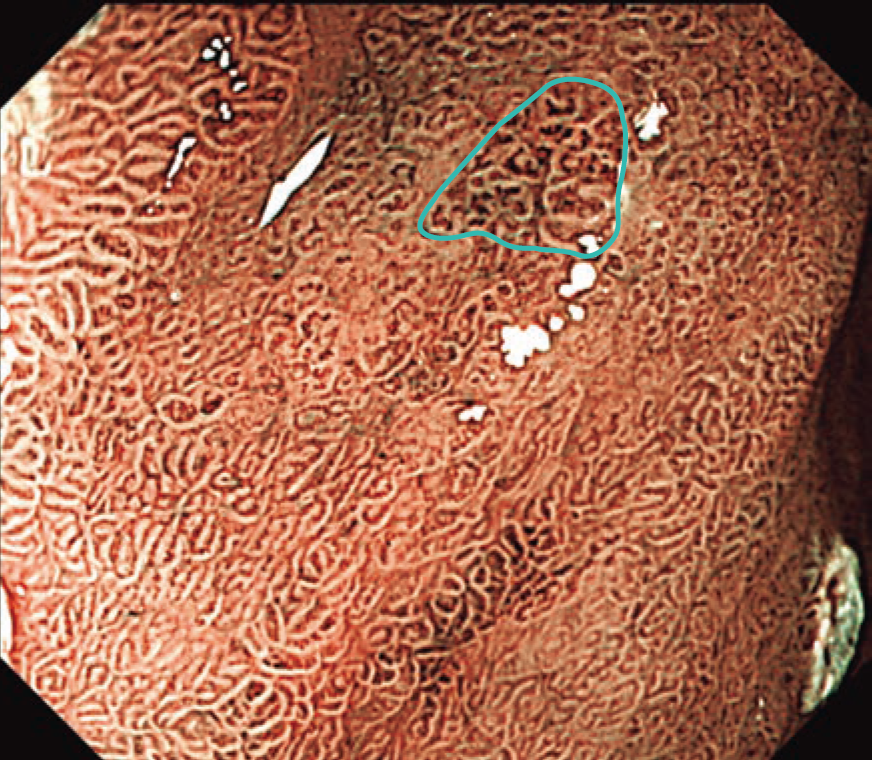 医学界新聞プラス ［第2回］H. pylori 除菌後胃癌――非腫瘍上皮の被覆