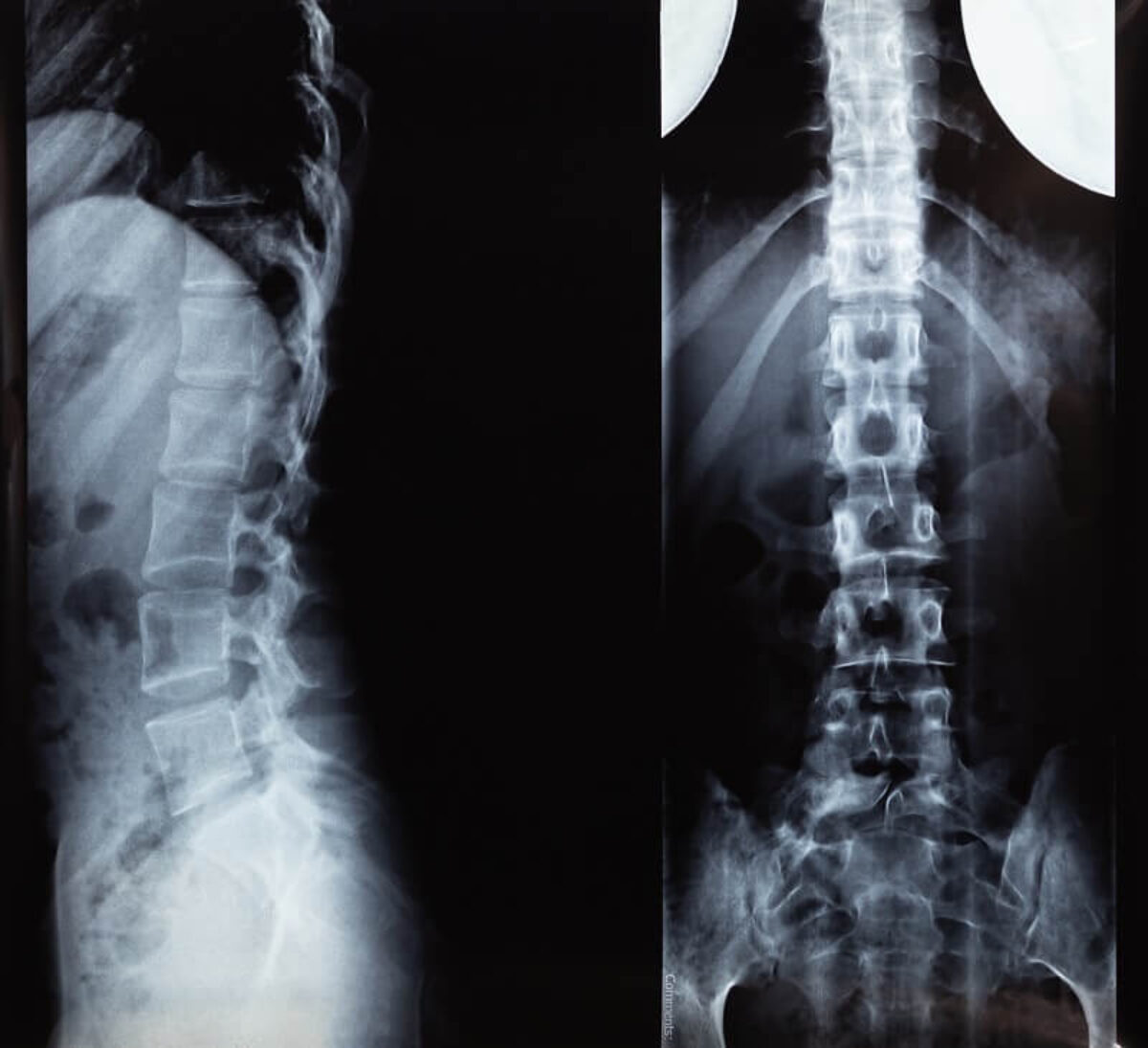 Common Spine Disorders: Diagnosing and Treating Back Pain
