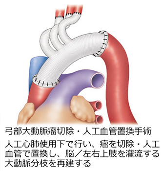 開胸手術と胸部大動脈ステントグラフト手術について｜心臓血管センター