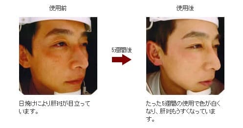 メラフェードでスキンケア｜京都・滋賀の大西皮フ科形成外科医院【大津