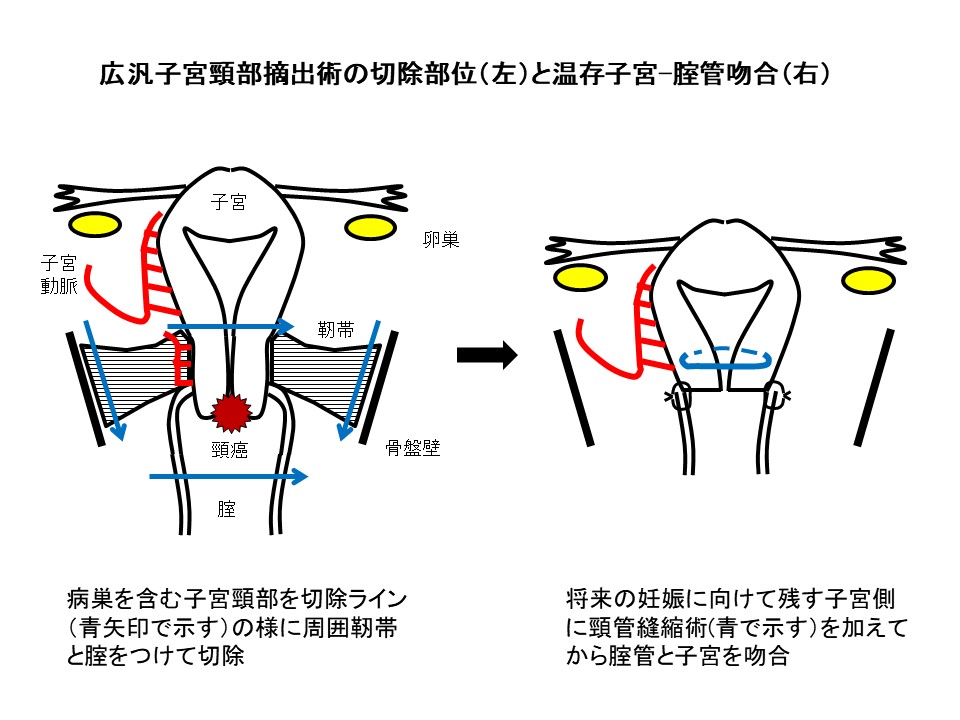 婦人科腫瘍｜鹿児島大学医学部産婦人科学教室