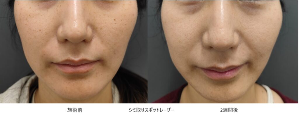 レーザーで全顔のシミ・そばかすを除去した症例①
