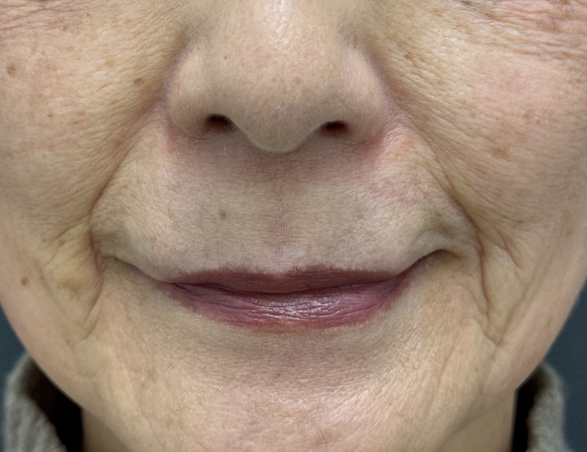 口角まで伸びる「長いほうれい線」が老け顔に？原因と改善方法を解説