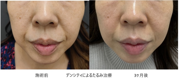 ほうれい線が「できやすい人」の特徴20選