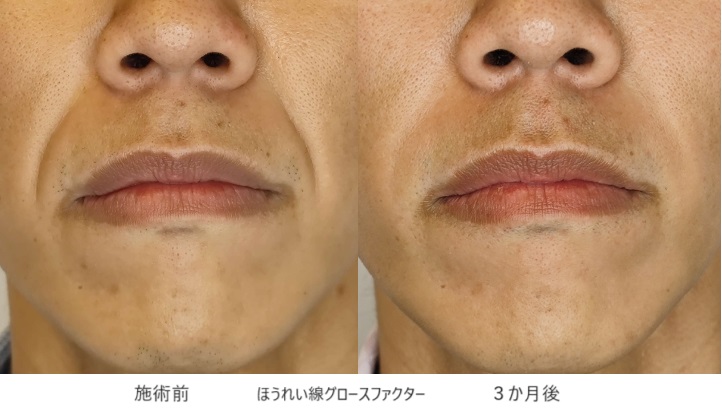 男性のほうれい線を1回で気づかれずに長期間解消する治療