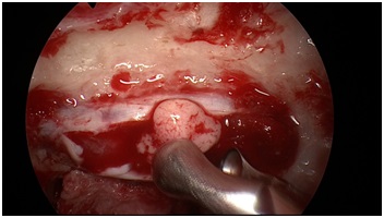 内視鏡下経鼻的下垂体手術 | 脳神経外科 | 【公式】 大阪市立総合医療