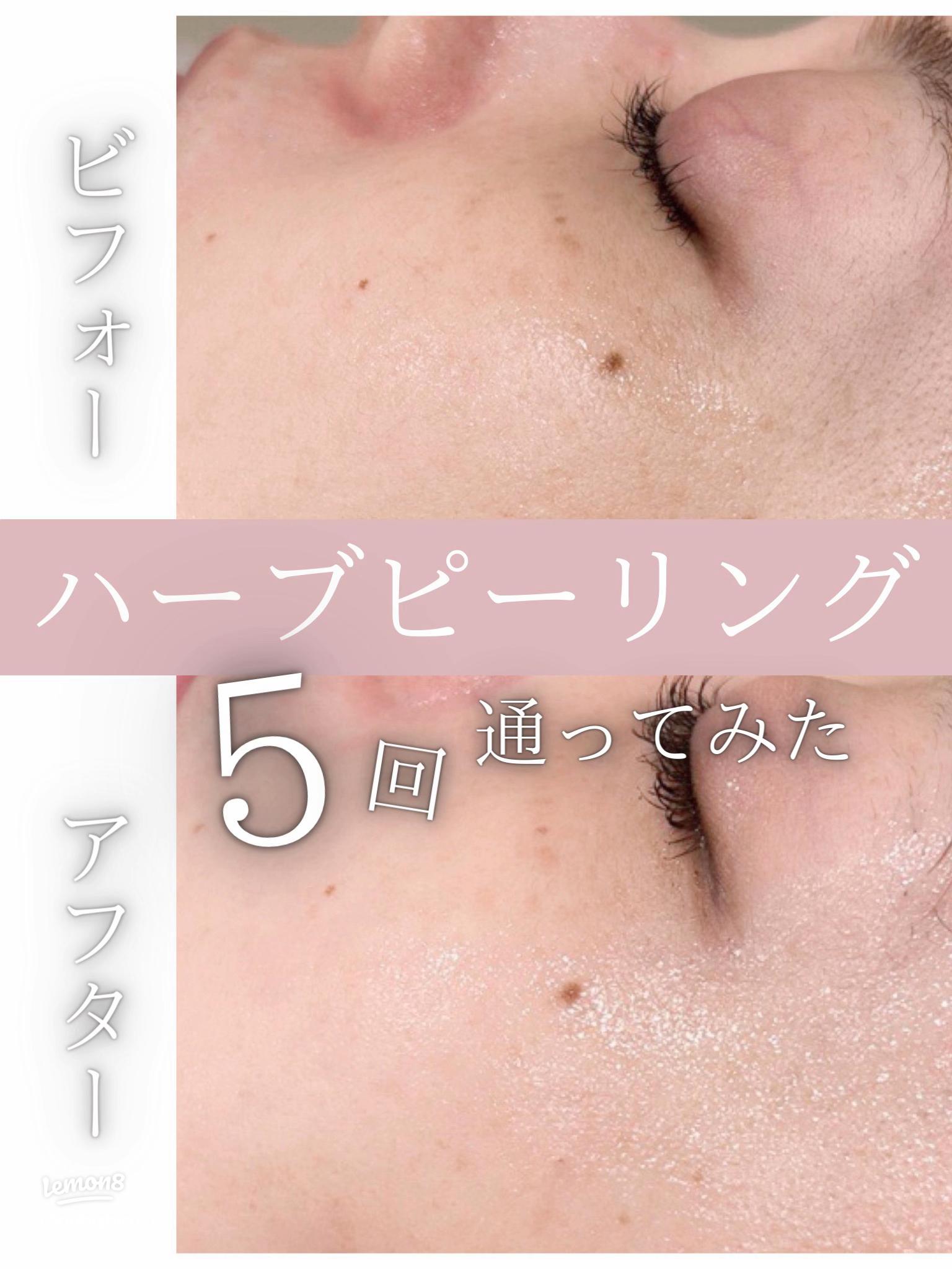 REVI陶肌ピーリング5回の成果と感想