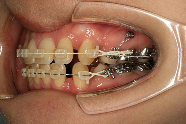 どんなふうに変わるの？ | みむら矯正歯科