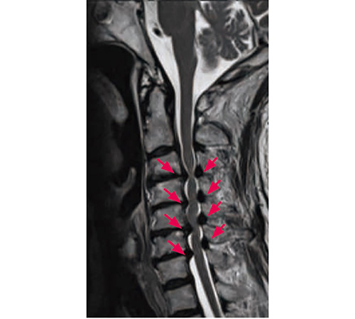 頸椎症性脊髄症の治療│近畿大学病院