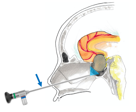 頭蓋底外科｜診療内容｜臨床｜神戸大学医学部附属病院 脳神経外科