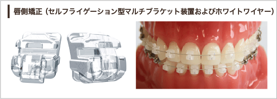 矯正治療のご案内