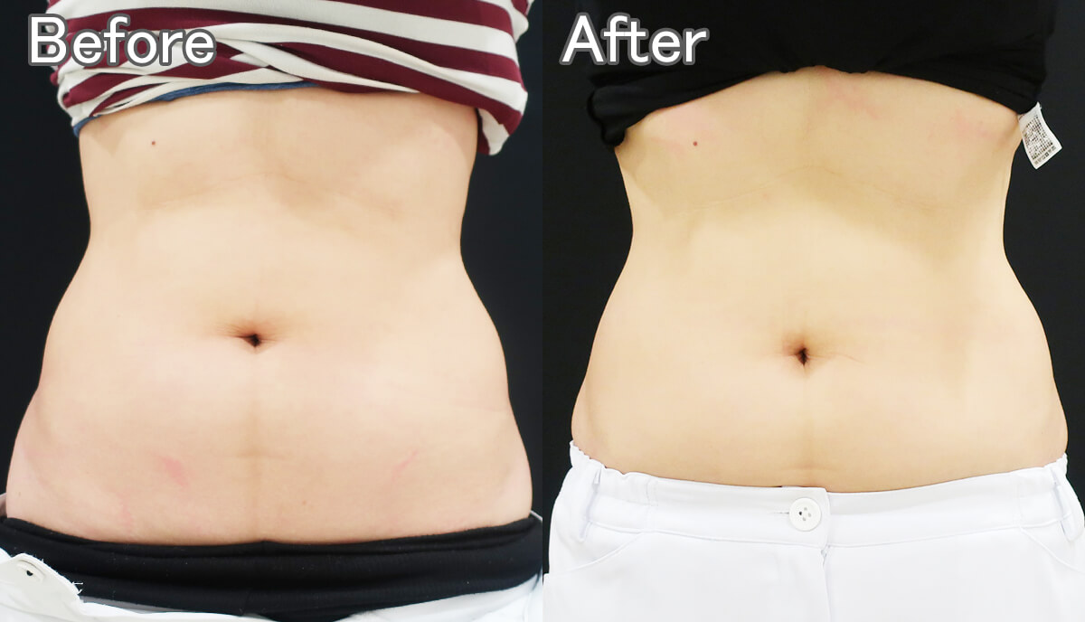 脂肪冷却 - 東京 渋谷 美容皮膚科 マグノリア皮膚科クリニック