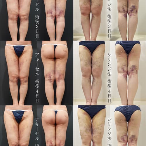 施術部位のケア・ストレッチ動画｜水の森美容クリニック 脂肪吸引