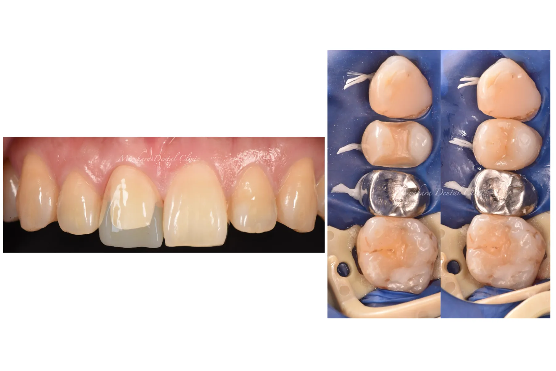 審美歯科 - 三鷹の歯医者｜みずはら歯科・矯正歯科 三鷹｜平日19時