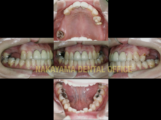 顎関節症、噛み合わせの治療 - ナカヤマデンタルオフィス（中央区築地駅）
