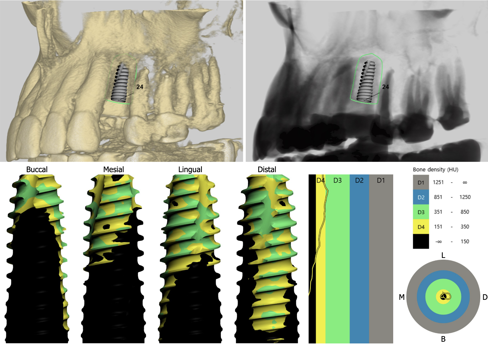 噛み合わせと顎の痛みを解消した包括的インプラント治療 | 名取歯科医院