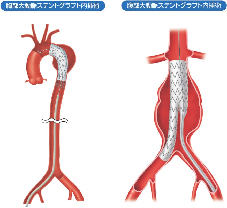 ステントグラフト内挿術 - 長野中央病院 心臓病センター