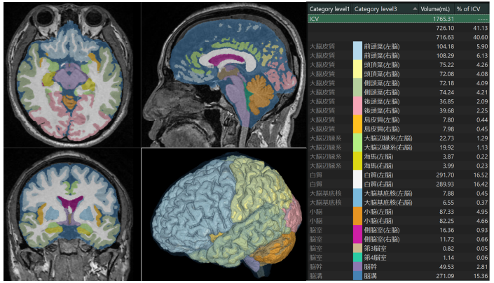 AI（⼈⼯知能）を使って、MRI から脳と脳脊髄液を正確に⾃動領域分割し