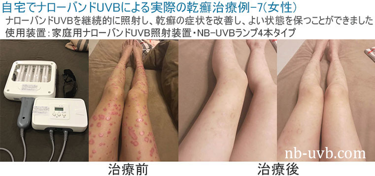 家庭用ナローバンドUVB(311nm)照射装置[個人輸入]｜在宅での(白斑