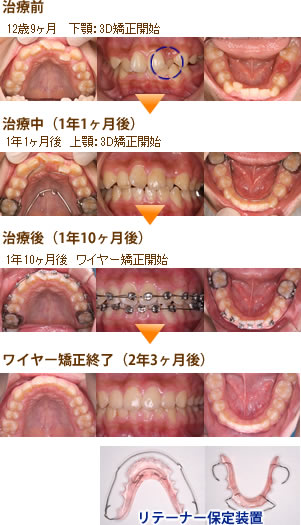 中学生からの矯正 | にしお歯科