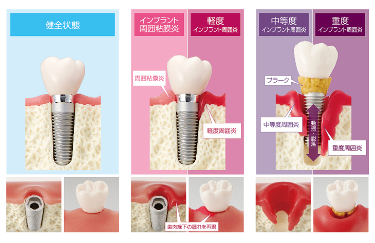 インプラント周囲病変模型 [PE-IMP004]｜株式会社ニッシン｜歯科模型