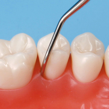 SRP用顎模型 [D18HD-500H(GUB)-MF](咬合器なし)｜株式会社ニッシン