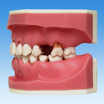歯周病学基礎実習用顎模型(歯槽歯肉ピンク色・D咬合器つき) [PER1032