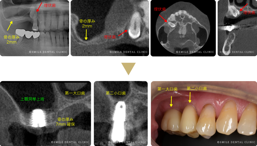 インプラント症例