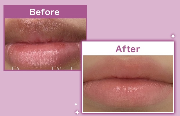 ローマピンク,黒ずみ,色素沈着,トーンアップ |福岡・天神・大名の美容