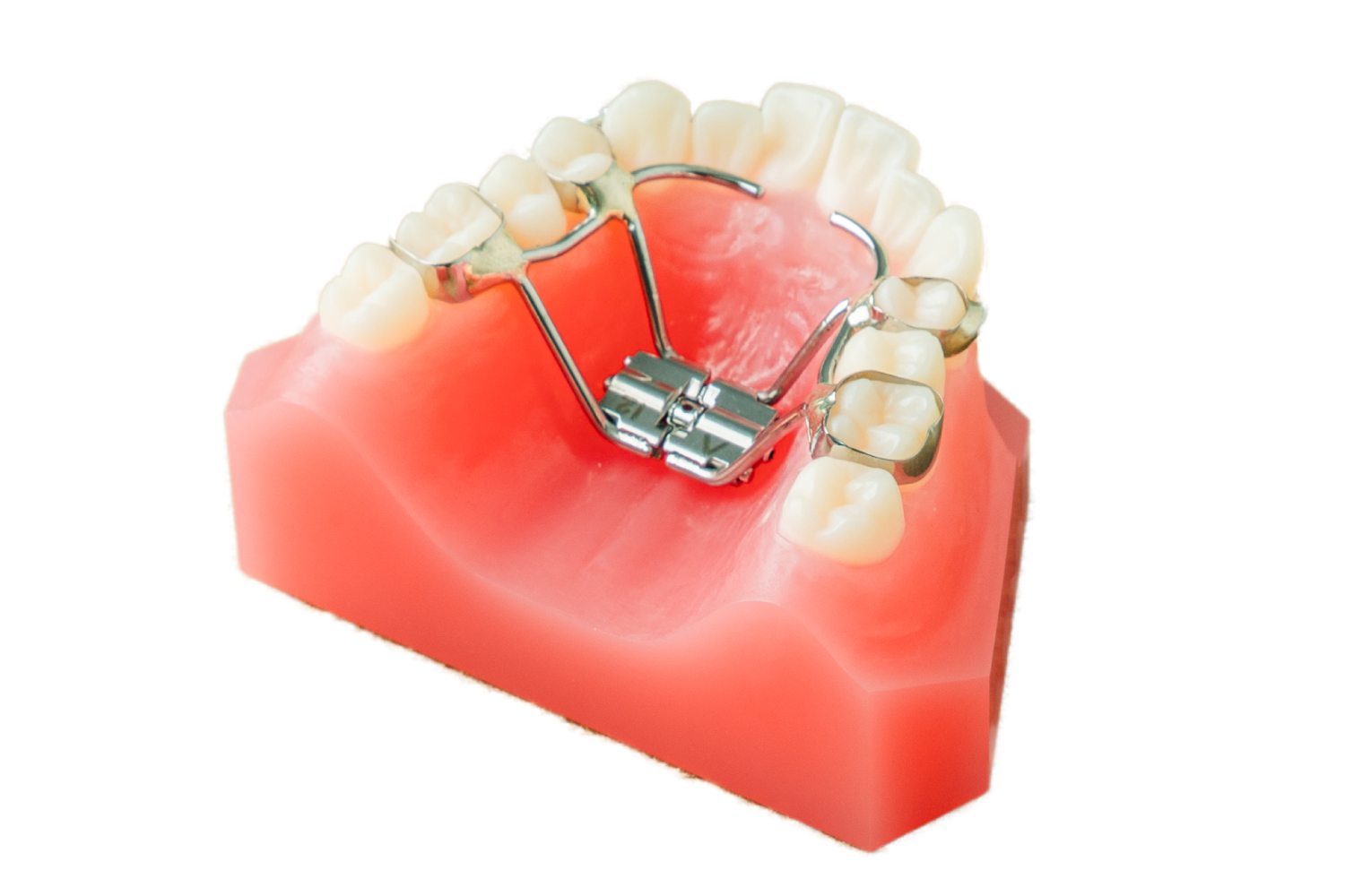 大阪堺で実績の小児矯正！6歳からはじめて美しい歯並びを！難症例実績