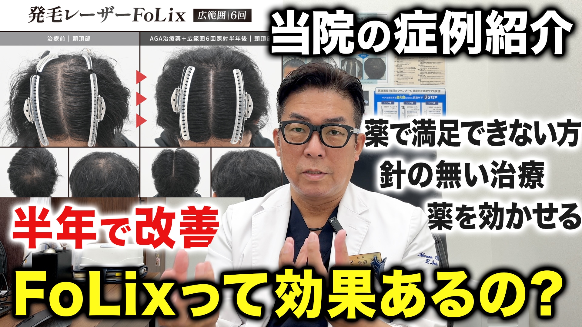 解説】発毛レーザーFoLix（フォリックス）の効果を実際の写真から解説 -