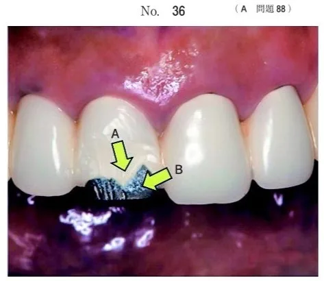 歯科医師国家試験 第113回 A88問題 | 歯科国試ドットコム
