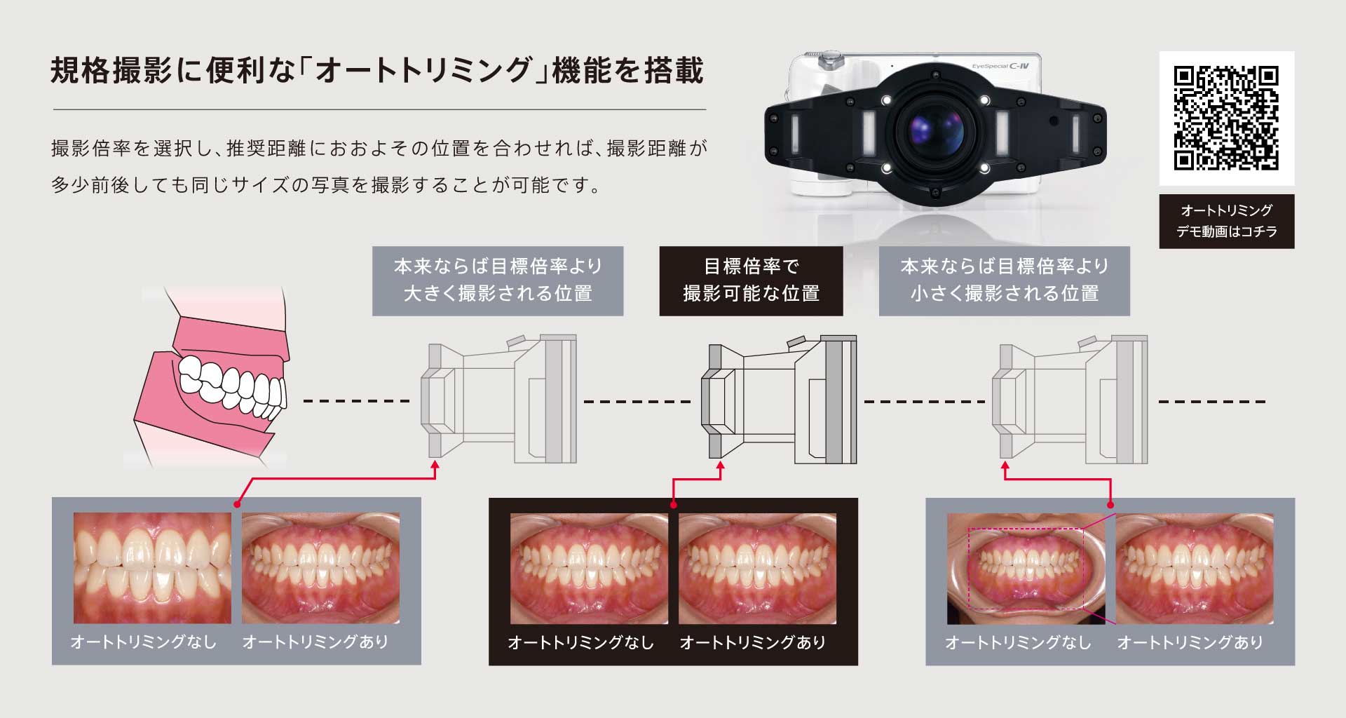 松風 口腔内撮影キット（口腔内撮影用ミラー/松風 口角鈎） | 株式会社