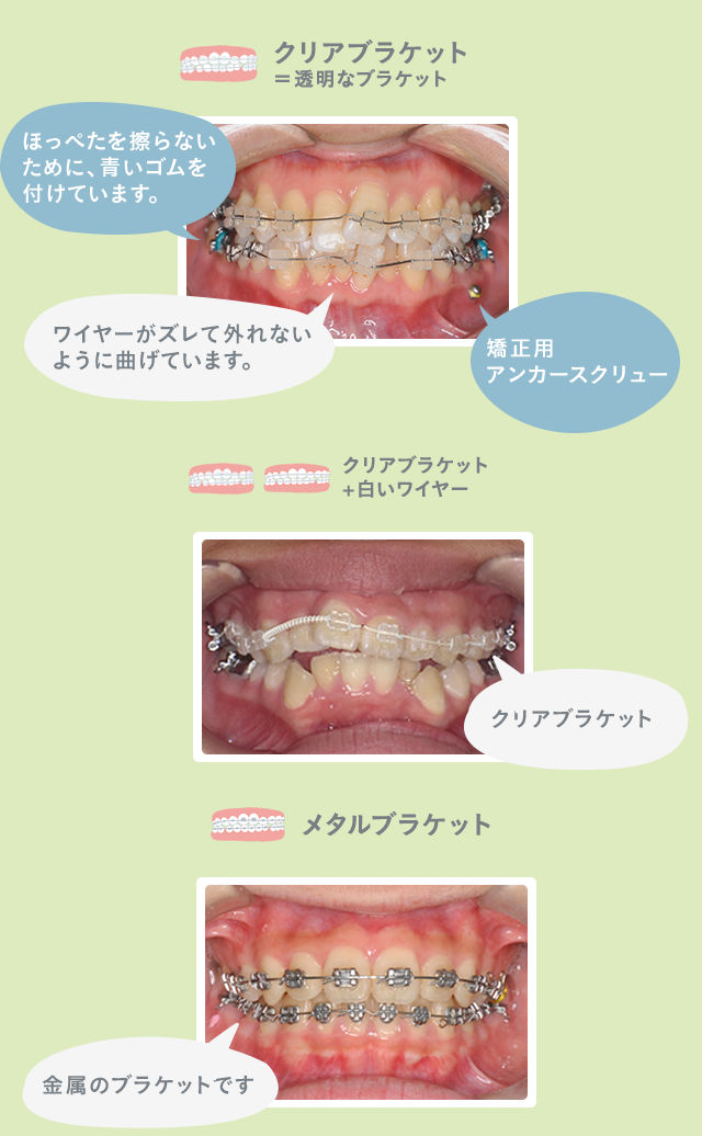 矯正装置 | 藤沢・辻堂・茅ヶ崎・大船・鎌倉 小児矯正・噛み合わせ