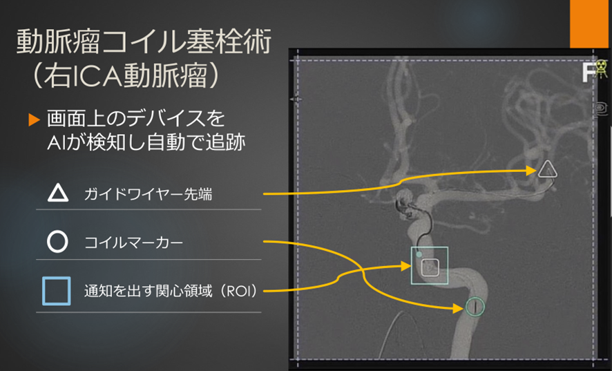 脳血管内治療｜昭和医科大学病院