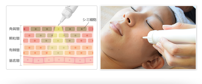 純日本製 シミケア 専用 美容機器『misireltoII（ミシレルトII）』